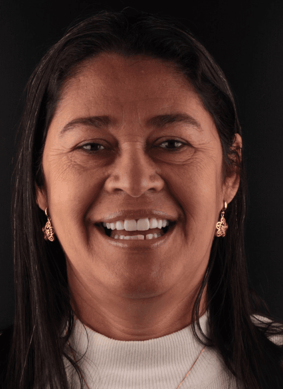 Depois – Paciente 3